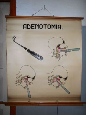 Adenotomia